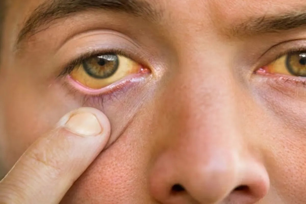 jaundice infection: