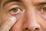 jaundice infection: